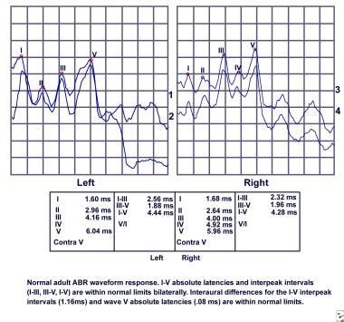 abr results interpretation|abr test for adults.